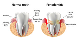 Healthy-smile-dental-Underood-periodontitis-teeth-decay-Calamvale