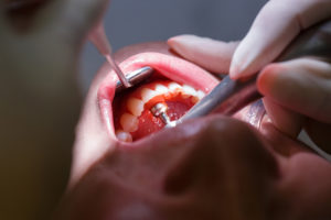 Healthy-smile-dental-Underood-periodontitis-teeth-decay-Calamvale-dentist