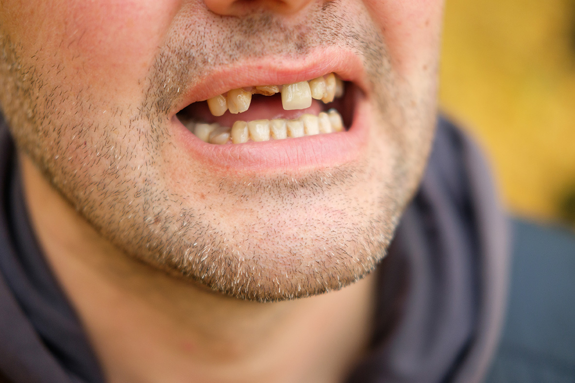 risk-of-missing-tooth-Browns-plains-dentist