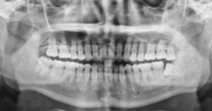 Healthy-Smile-dental-OPG-X-Ray-machine