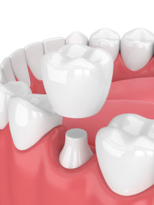Healthy-Smile-Dentral-crown-calamvale-dentist