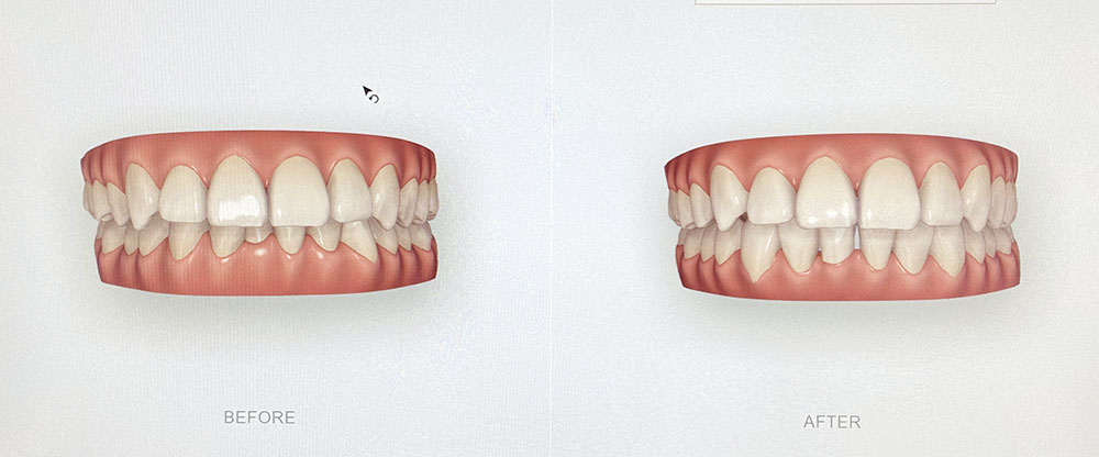 Healthy-Smile-dental-3D-scanner-teeth