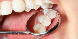 fissure sealant