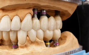 Dental Implant Model