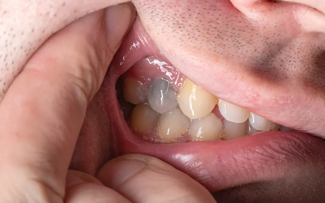 Did your tooth turn dark after root canal therapy?