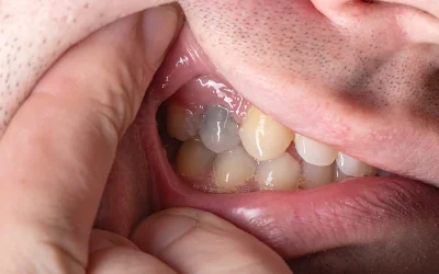 Did your tooth turn dark after root canal therapy?