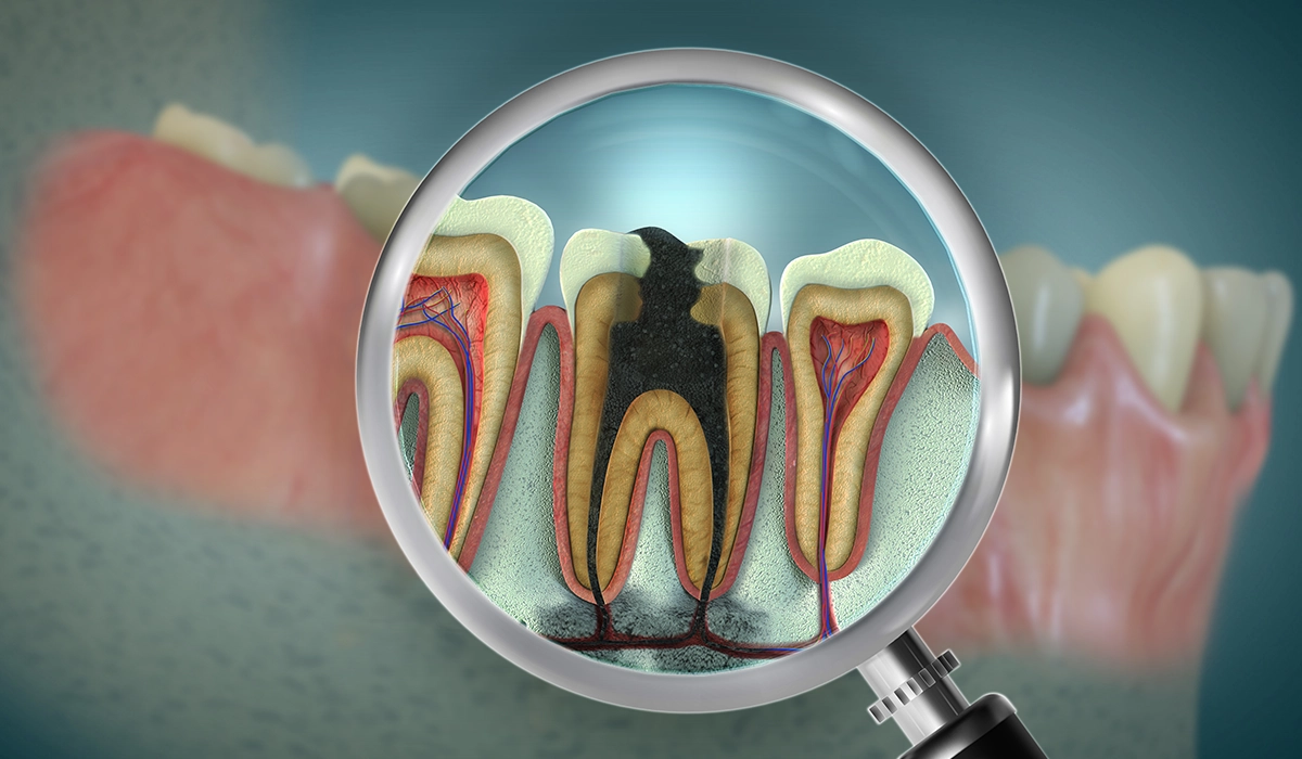 Did your tooth turn dark after root canal therapy