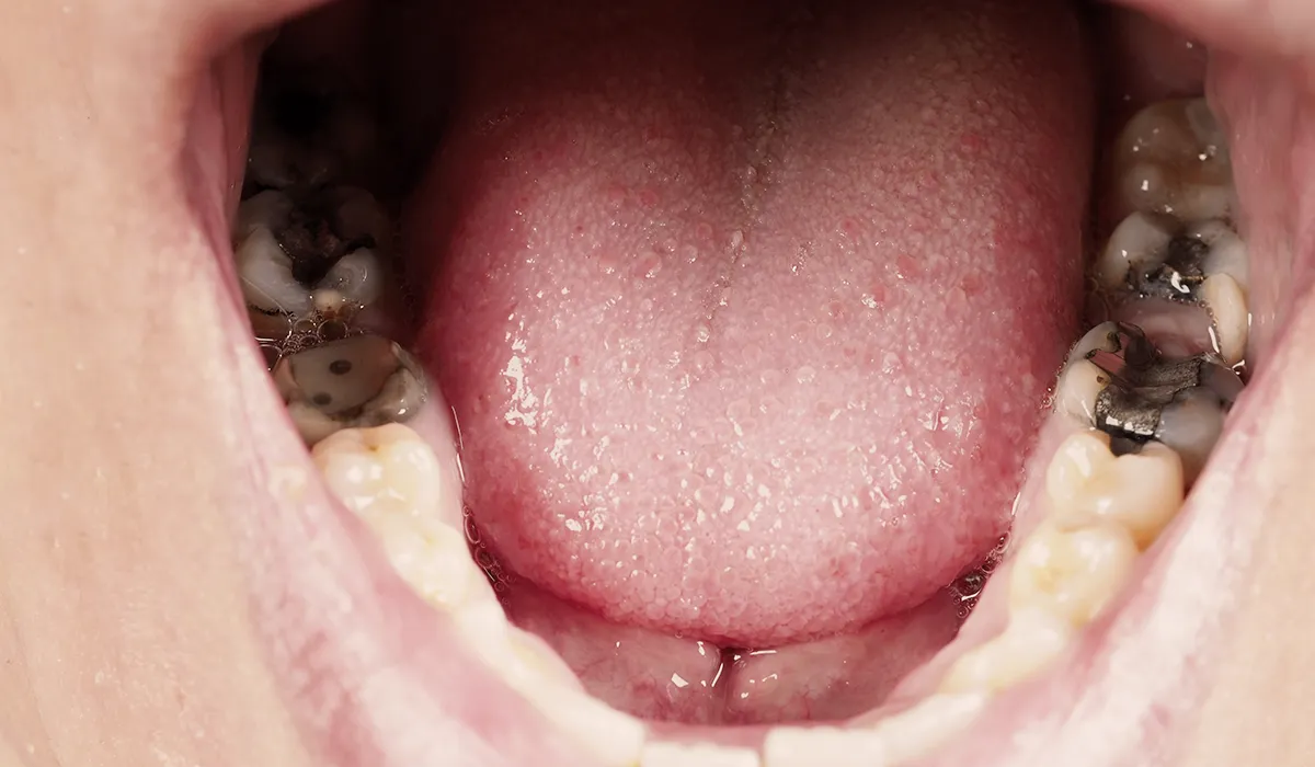 Tooth decay Tooth decay