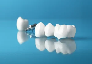 Dental crowns and bridges