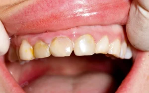 Enamel erosion