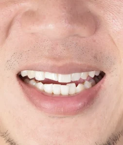 broken tooth