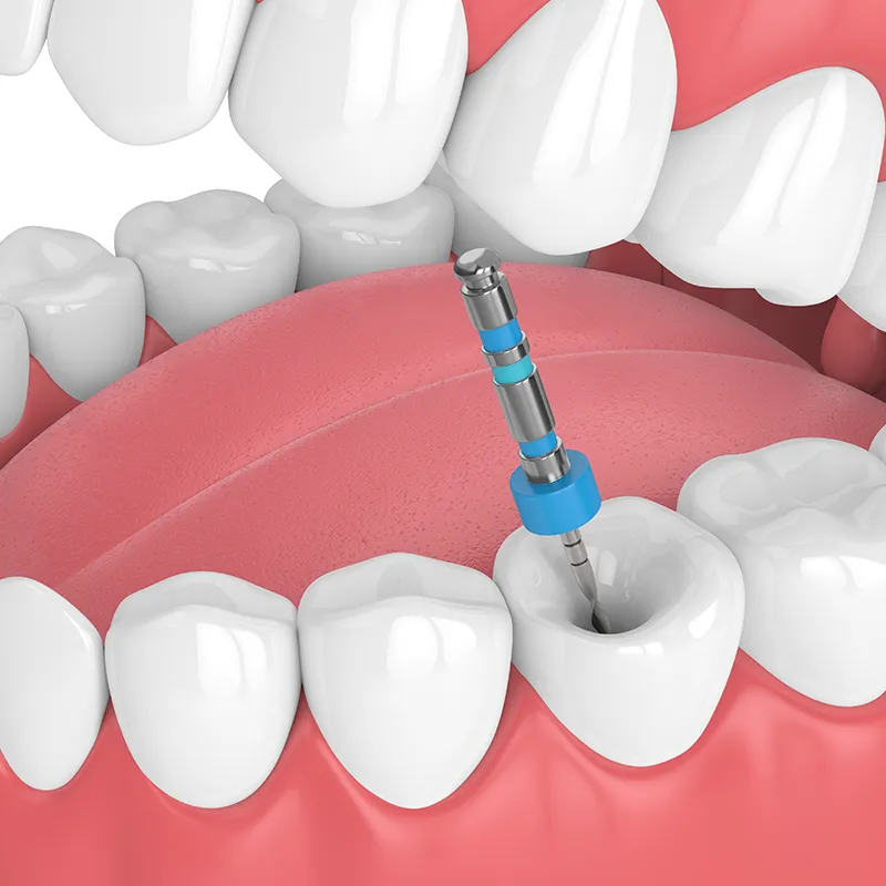 Root Canal Therapy Root Canal Therapy