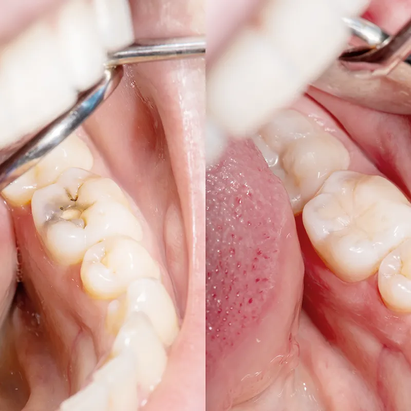 Root Canal Therapy Root Canal Therapy