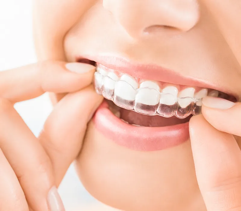 Invisalign