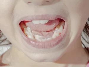 misaligned teeth