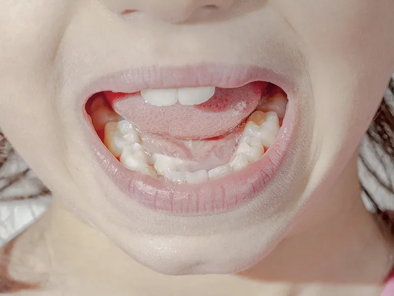 misaligned teeth