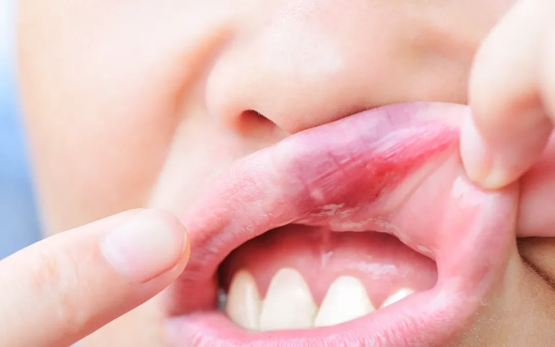 That denture soreness might be a fungal infection