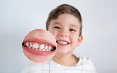 Checking kids’ teeth for dental fluorosis