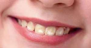 Checking kids’ teeth for dental fluorosis