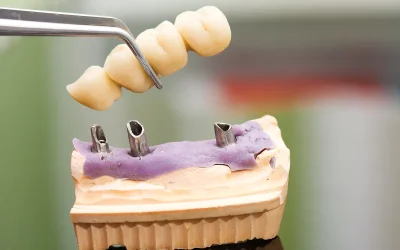 Custom dental bridge that prevents long-term bite shifting