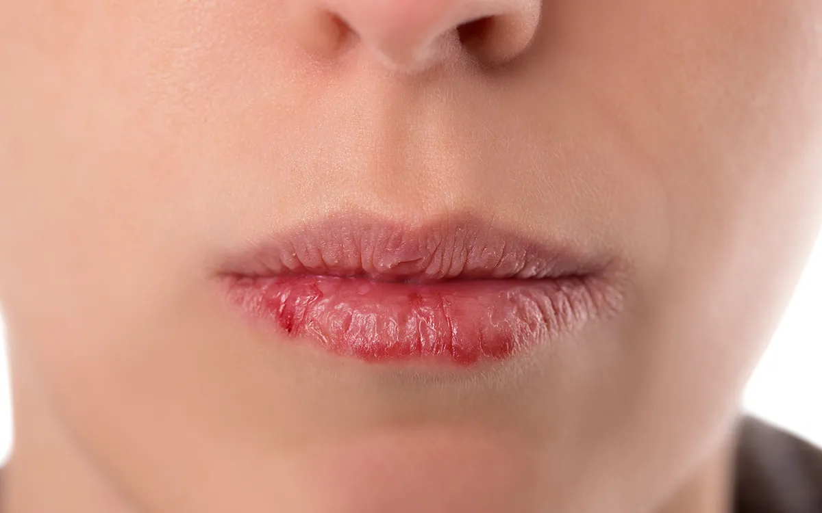Dry mouth
