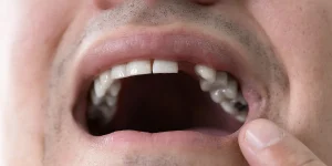 How a missing tooth can affect your quality of life