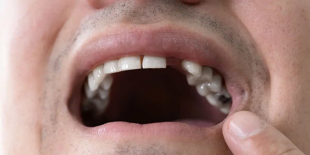 How a missing tooth can affect your quality of life