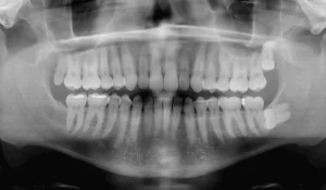 wisdom teeth
